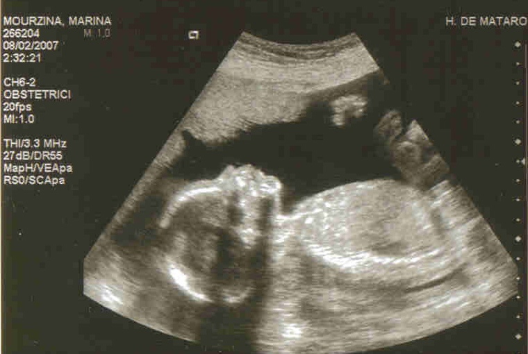 20 недель беременности фото плода на узи