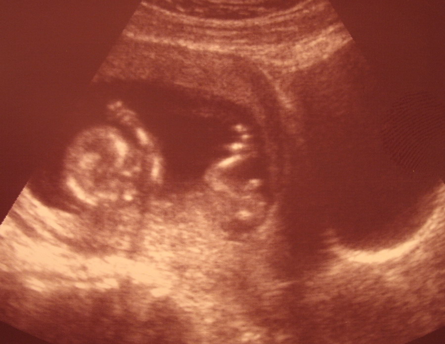 13 недель видео. Плод на 13 неделе беременности. 13 Недель беременности фото плода. 13 Недель беременности фото плода на УЗИ. УЗИ 11 недель беременности шевеление.
