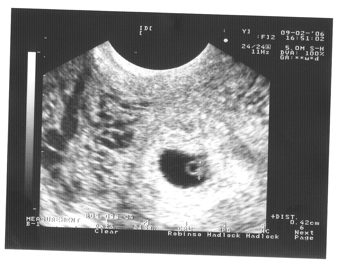 5 6 Недель Беременности Фото Эмбриона