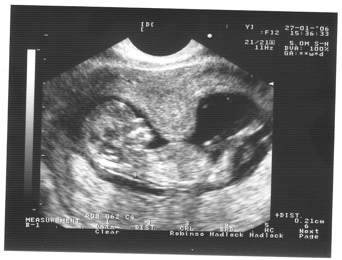 Тонус передней стенки матки. Гипертонус матки при беременности 2 триместр УЗИ. Тонус матки при беременности 1 триместр УЗИ. Гипертонус стенки матки при беременности 12 недель. Гипертонус матки на УЗИ при беременности.