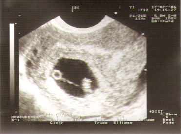 7 недель желточный. Однояйцевые Близнецы на УЗИ 8 недель беременности. Однояйцевые Близнецы на УЗИ 7 недель. УЗИ желточный мешок 5 неделя. УЗИ 6 недель беременности желточный мешок.